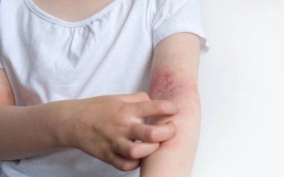 Šta je atopijski dermatitis?