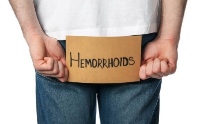 Upala hemoroida – koliko traje i kako se leči?